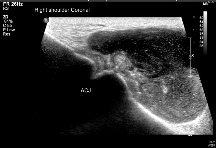Coronal ultrasound at Acromioclavicular joint